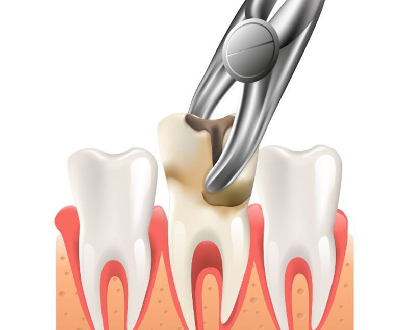 Tooth extraction in abu dhabi