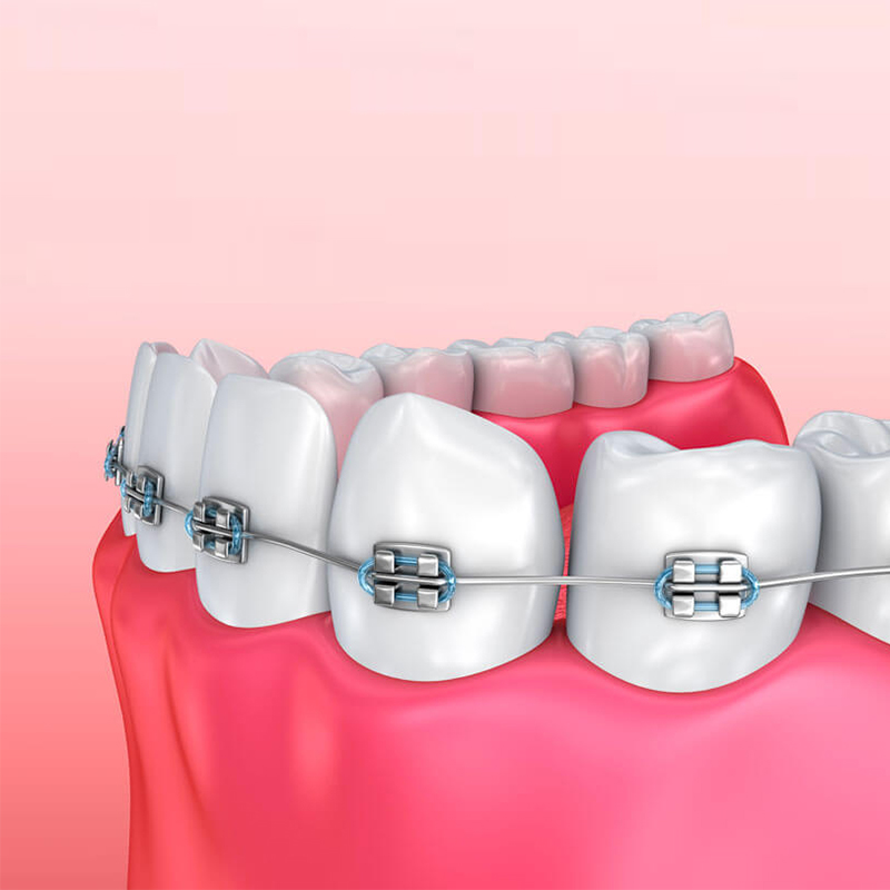 Dental braces in abu dhabi