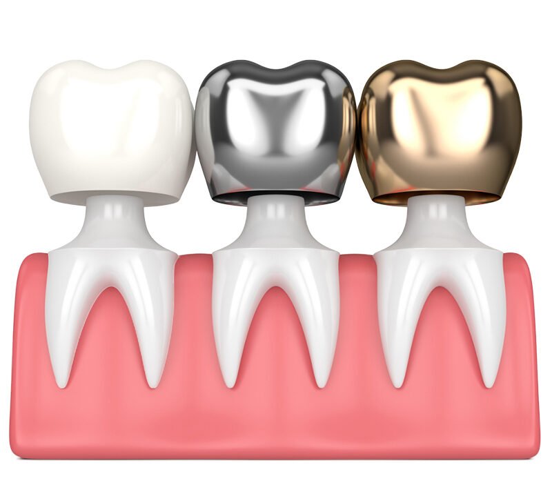 Dental crown in abu dhabi