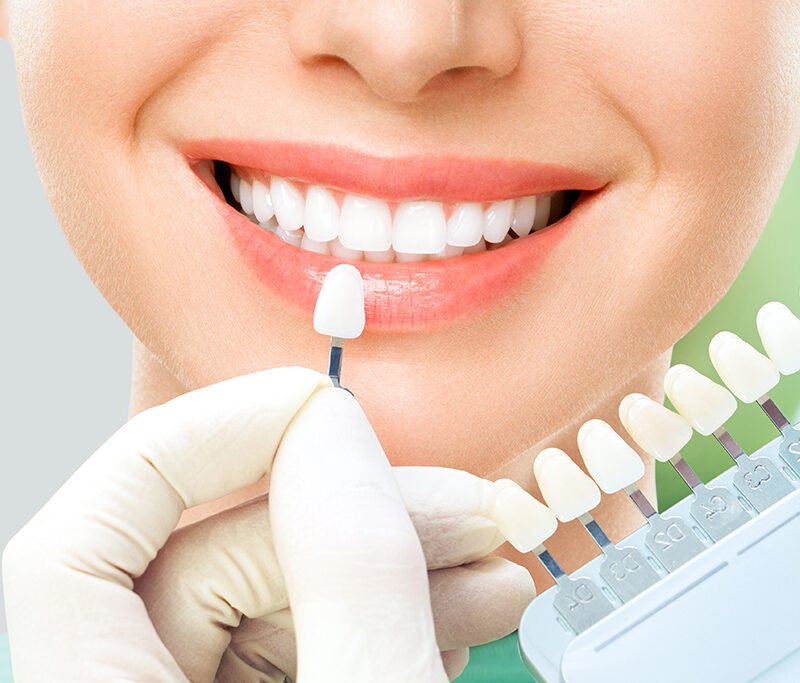 Dental veneers abu dhabi