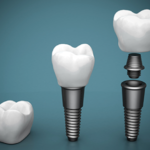 New Trends in Dental Implants Technology