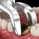Understanding Dental Extractions: Why and When They Are Necessary