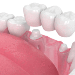 The Benefits of Dental Crowns: Why They’re Essential for Tooth Restoration