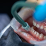 Preparing for Tooth Removal: Tips from Expert Dentists